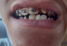 A ORTODONTIA EM EVOLUÇÃO : Quando a Fada dos Dentes não dá conta